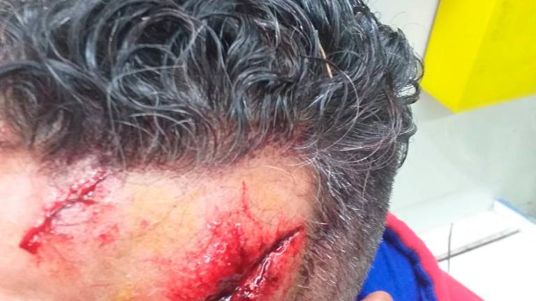 Un vecino de Cerro Molina termina herido tras evitar un robo Un vecino de Cerro Molina termina herido tras evitar un robo