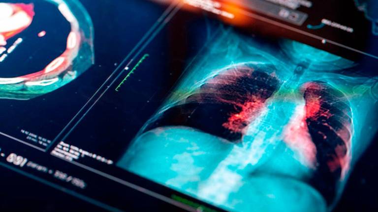 Nuevas conclusiones del estudio “NADIM II” sobre cáncer de pulmón Nuevas conclusiones del estudio “NADIM II” sobre cáncer de pulmón