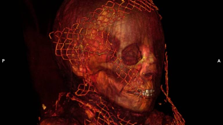 El Proyecto Qubbet el-Hawa de la UJA constata diversos métodos de momificación El Proyecto Qubbet el-Hawa de la UJA constata diversos métodos de momificación