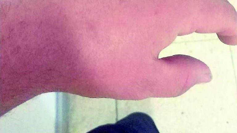 Un vecino denuncia su “calvario” tras la rotura de un hueso Un vecino denuncia su “calvario” tras la rotura de un hueso
