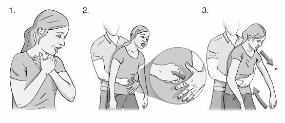 Maniobra de Heimlich