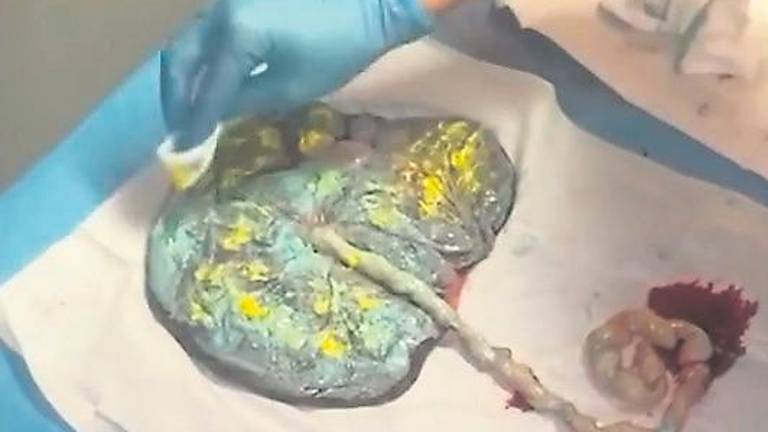 El Hospital de Andújar entrega a las madres una impresión de su placenta como recuerdo del parto