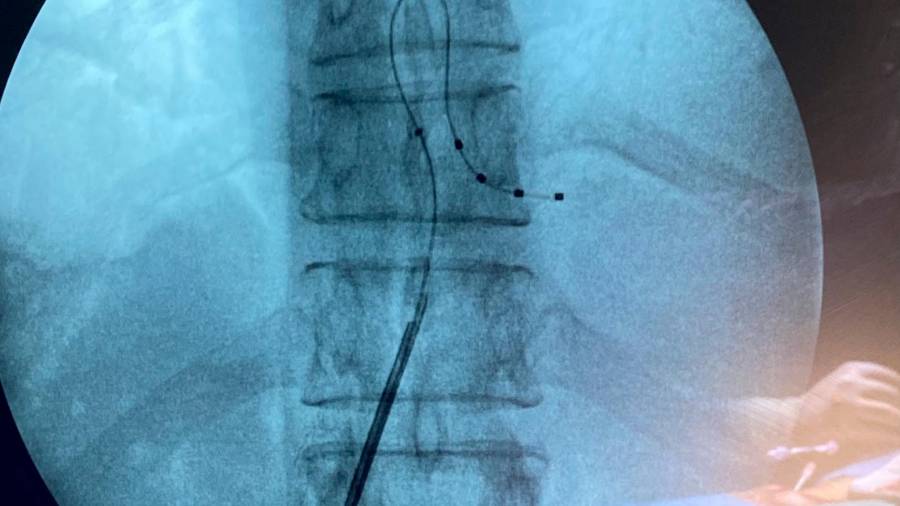 <i>Electrodo implantado en el hosital ubetense. / Juan de Andalucía. </i>