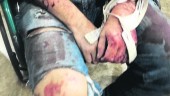 DENUNCIA. Heridas causadas por los perros, de la raza rottweiler, al hombre, durante el ataque sufrido con su pareja en un olivar. 