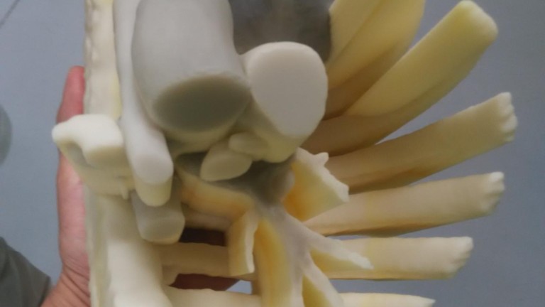 Fabrican en Martos un modelo 3D para facilitar la operación del tumor en el pecho de una niña
